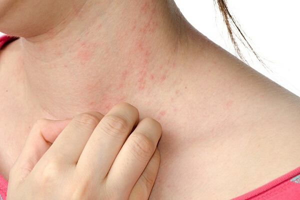 ORVOSI SZÓTÁR - Bõrrel érintkezõ élelmiszer okozta nem specifikus kontakt dermatitis jelentése