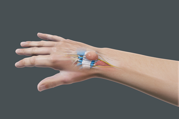 Ganglio de la muñeca: tipos, causas, síntomas, tratamiento, ejercicios