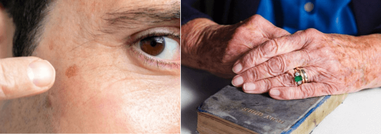 Prevención de manchas de hígado en la cara, manos y piel