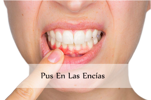 Pus en las encías