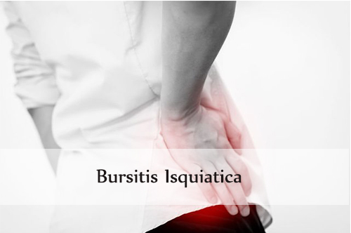 bursitis isquiatica
