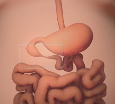 Atresia yeyunoileal