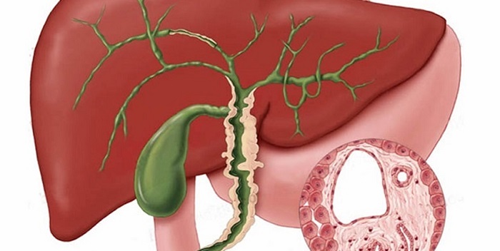 Colangitis esclerosante primaria