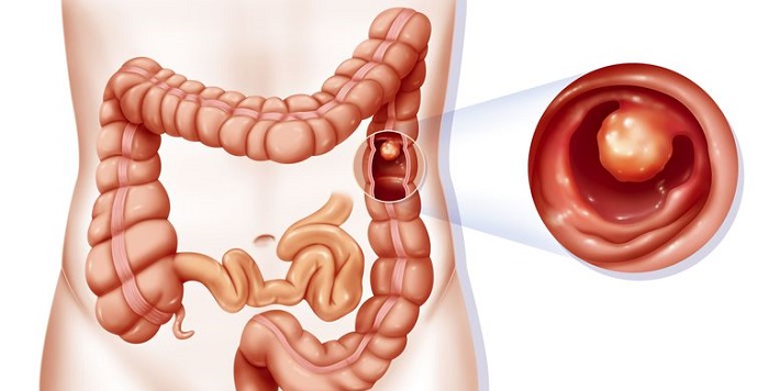 Los pólipos de colon