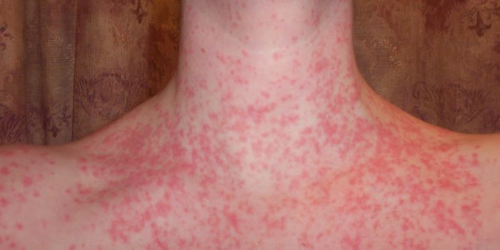 Psoriasis guttata causas, síntomas, tratamiento