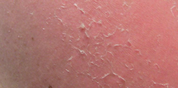 Qué es el Síndrome de Peeling de la Piel Causas, Síntomas, Tratamiento, Diagnóstico