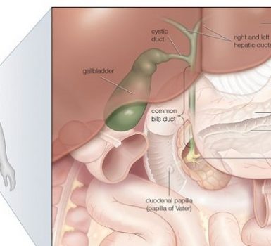 Qué es la colangitis ascendente y cómo se trata