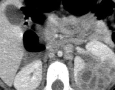 absceso renal