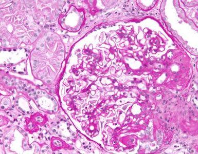 acidosis tubular renal rta