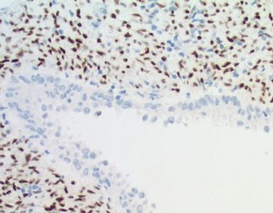 angiomiolipoma