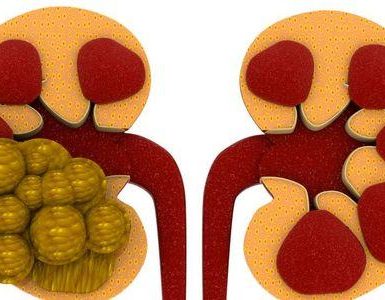 cálculos renales o cálculo renal