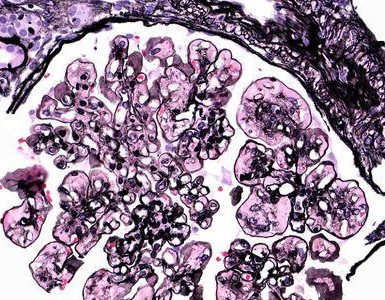 glomerulopatía fibronectina