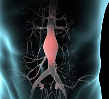 Qué es el aneurisma aórtico abdominal y cómo se repara