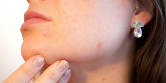 Cuál es el significado del acné vulgar