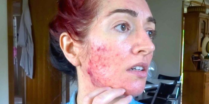 Cuánto tiempo debe tomar Accutane para tratar el acné y cómo funciona