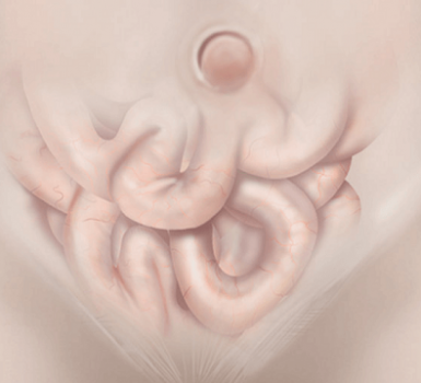 Hernia umbilical