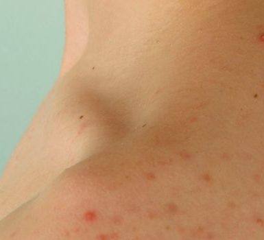 Qué es el acné inflamatorio vulgar causas, síntomas, tratamiento, autocuidado