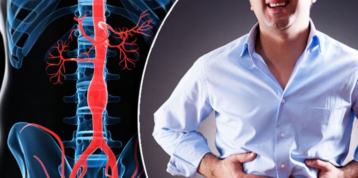 Qué provoca un aneurisma abdominal