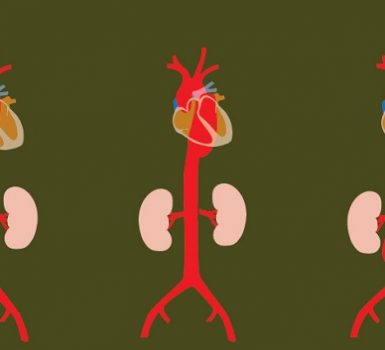 Qué se puede hacer para una aorta agrandada
