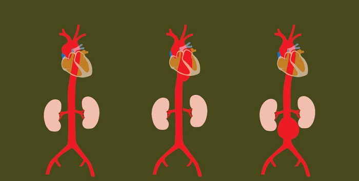 Qué se puede hacer para una aorta agrandada