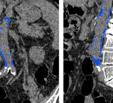Qué tan grave es la calcificación de la aorta