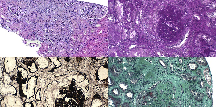 Vasculitis antineutrófila citoplasmática de autoanticuerpos