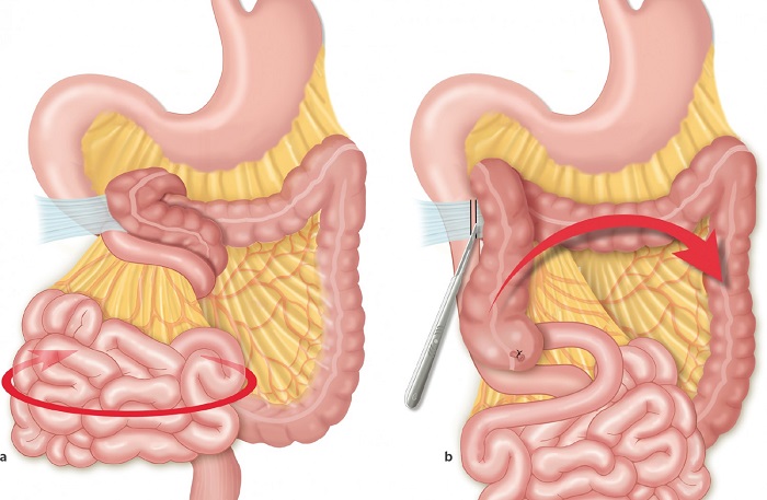 Vólvulo del intestino medio