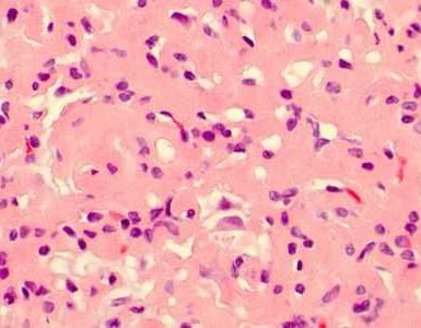 glomerulonefritis fibrilar