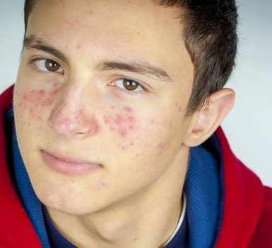 Cuánto dura el acné de la pubertad
