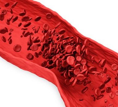 Qué alimentos debe comer para prevenir los coágulos de sangre Hierbas beneficiosas para deshacerse de los coágulos de sangre