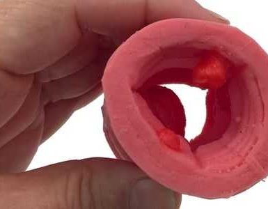 ¿Qué pasa si un pólipo de colon es canceroso?