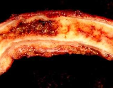apendicitis aguda