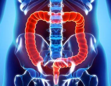 megacolon tóxico