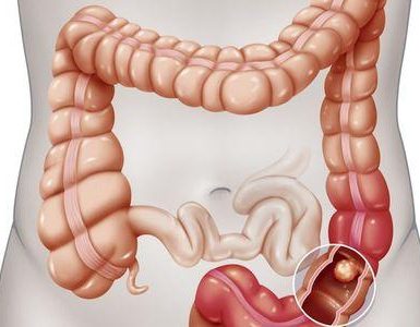 obstrucción intestinal