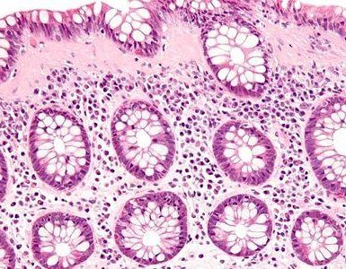 colitis microscópica
