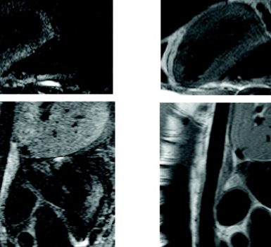 Aortitis