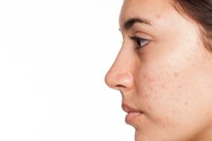 Beneficios de la terapia de luz para el acné y sus efectos secundarios