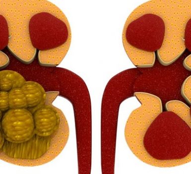 Cómo prevenir la nefritis