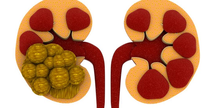 Cómo prevenir la nefritis