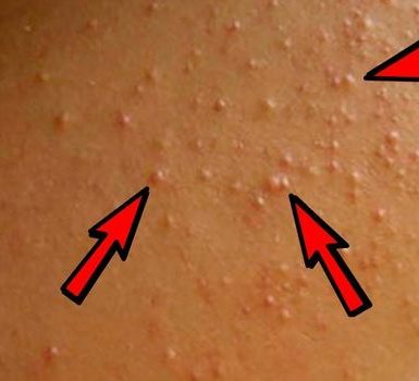 Dieta para la queratosis pilar alimentos para tomar y alimentos para evitar