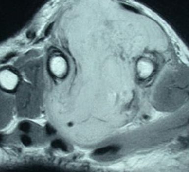 Qué comer cuando tienes un tumor de la vaina nerviosa