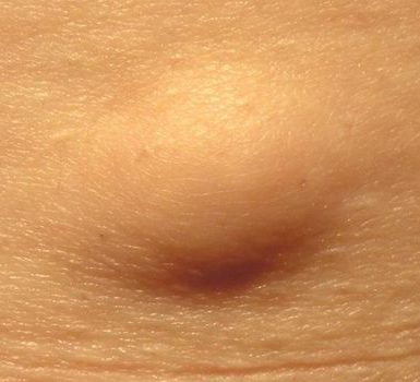 Qué es una buena dieta para lipoma